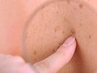 Công nghệ máy ảnh mới giúp con người phát hiện sớm ung thư da