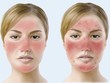 Làm thế nào để không bị đỏ mặt khi uống rượu?