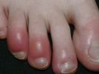 Một bệnh nhân mắc chứng cước ngón chân. Ảnh: Wikipedia.