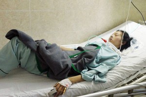 Một bệnh nhân nhập viện điều trị do ngộ độc botulinum sau khi ăn pate Minh Chay
