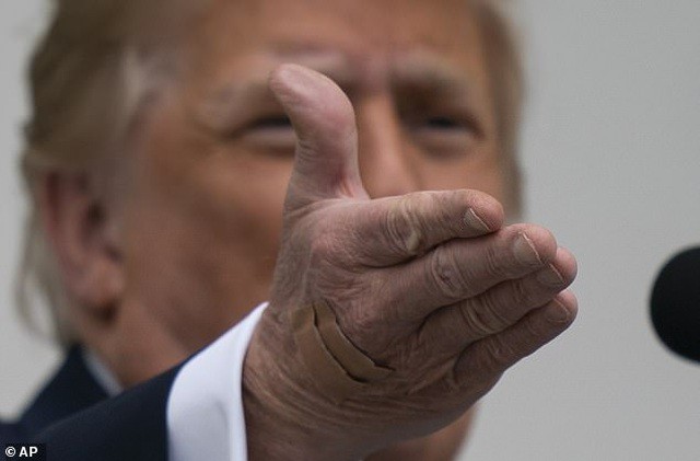 Miếng băng trên mu bàn tay ông Trump. (Ảnh: AP).